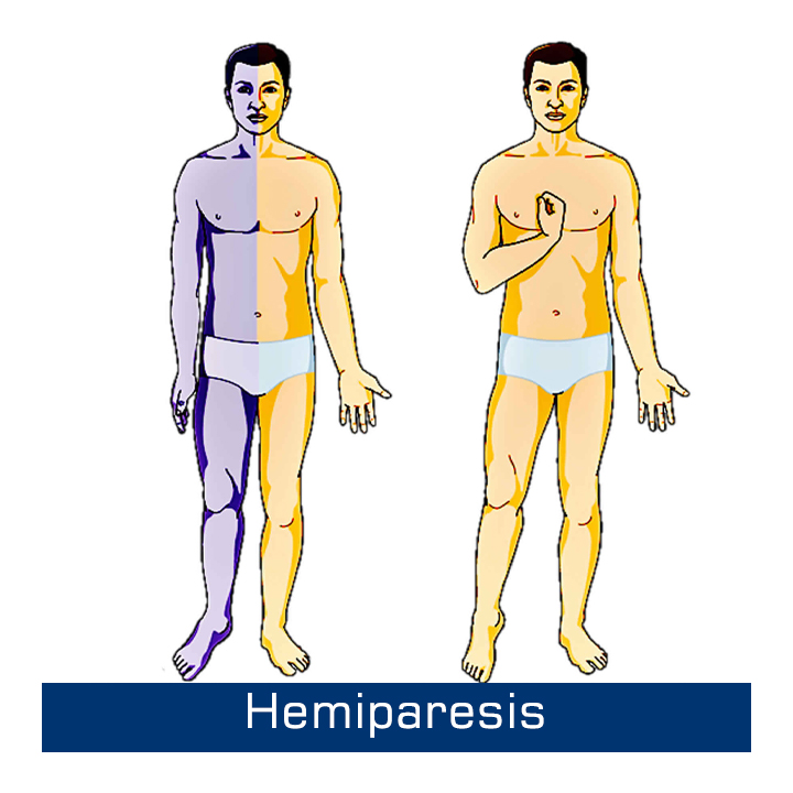 Hemiplegia
