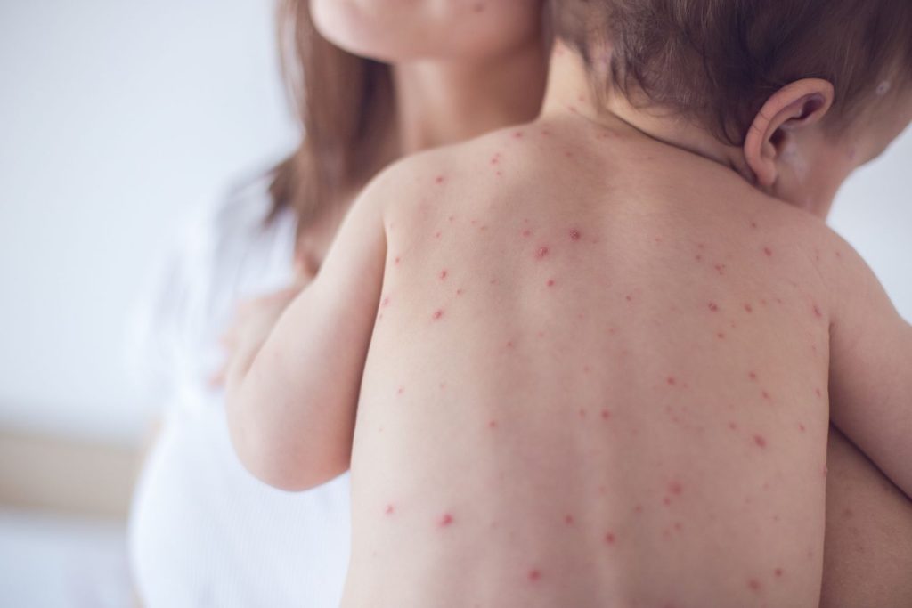 Measles - Symptoms & causes and solution