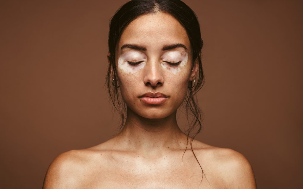 Vitiligo Vitiligo