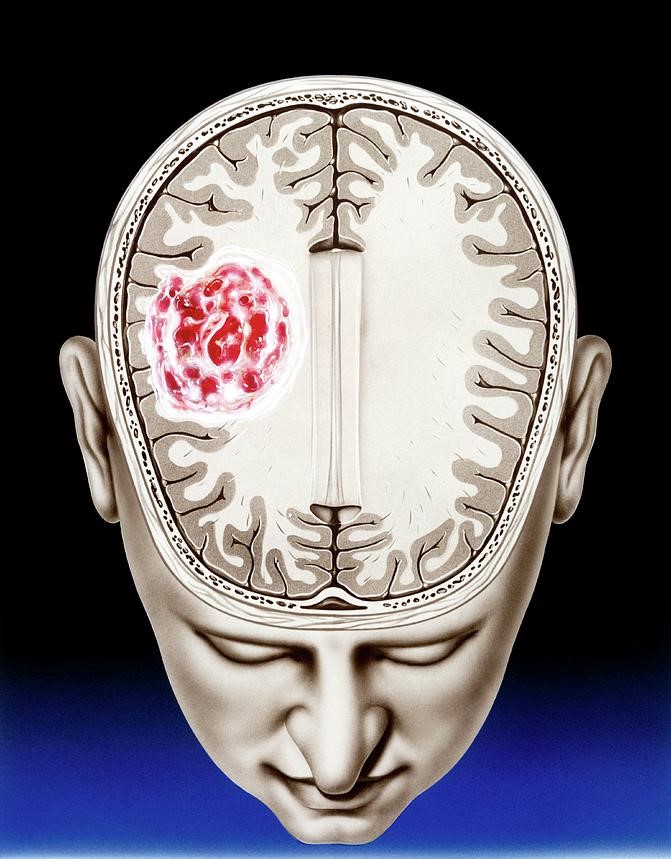 What is Glioma ? Glioma Brain Tumour John Bavosi 1