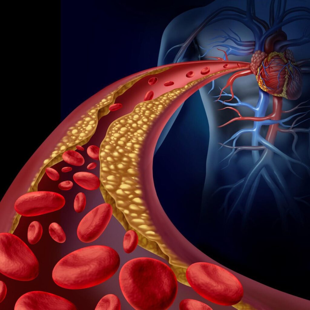 high blood cholesterol