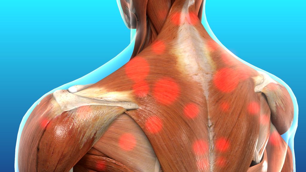 chronic myofascial pain