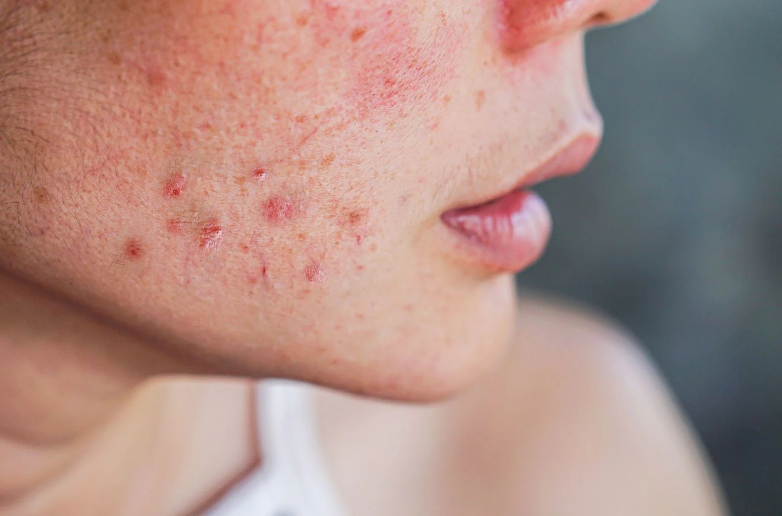 Pimples and how to reduce them