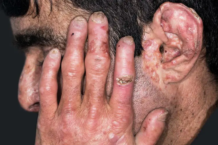 porphyria