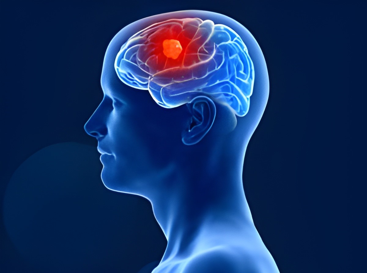 What is Glioma ?
